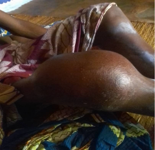 Intervention d’urgence pour un patient hémophile