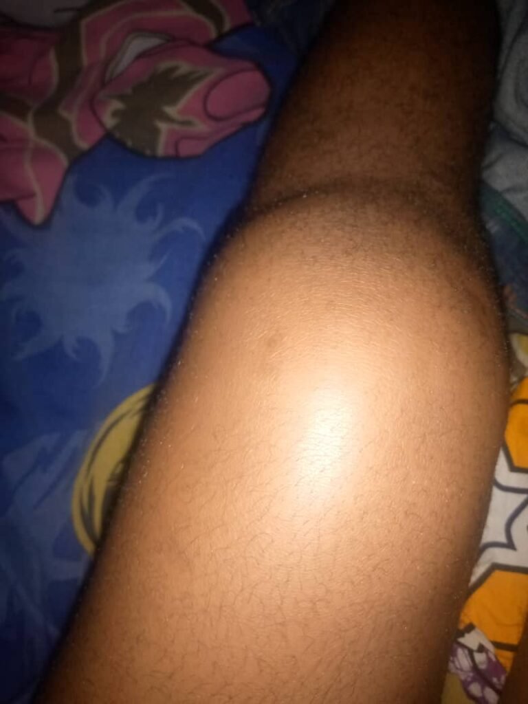 Association Béninoise des Hémophiles | ABH | Traitement Pour Tous ! - Donation