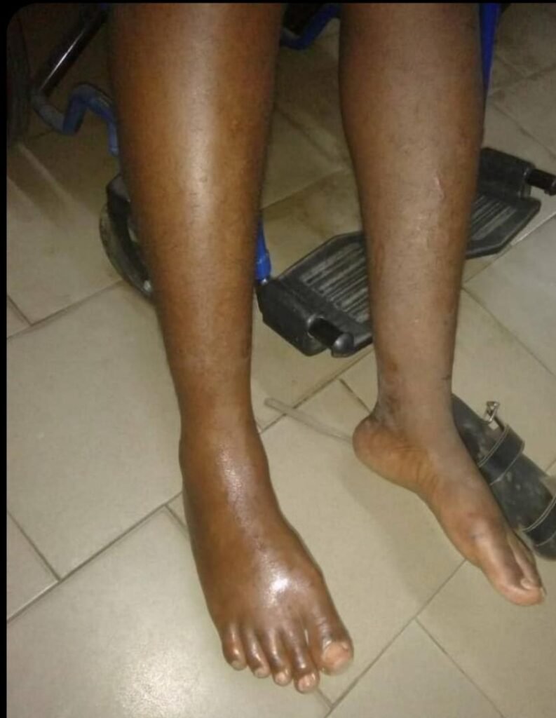 Association Béninoise des Hémophiles | ABH | Traitement Pour Tous ! - Donation